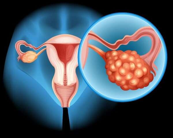 Ovarian Cysts Causes Symptoms And Treatment Bizeebuzz