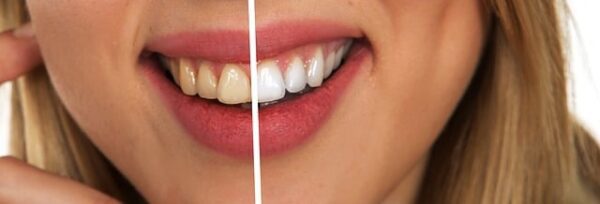 white-spots-on-teeth-after-whitening-causes-treatment-bizeebuzz